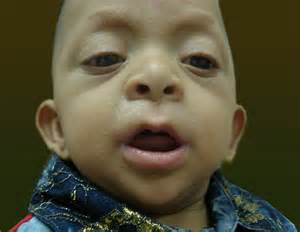 碘盐能吃出甲状腺病?还能好好吃盐吗?