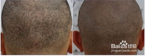 纹发 是如何解决脱发的？植发又怎么样呢？