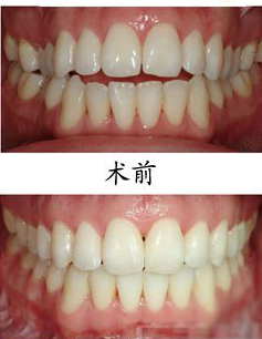 牙齿矫正前后对比图