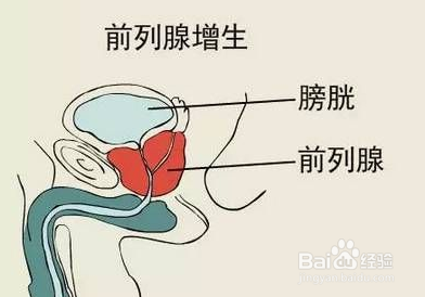 前列腺增生会影响男性性功能吗