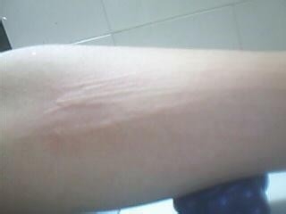 人工荨麻疹的有效治疗方法