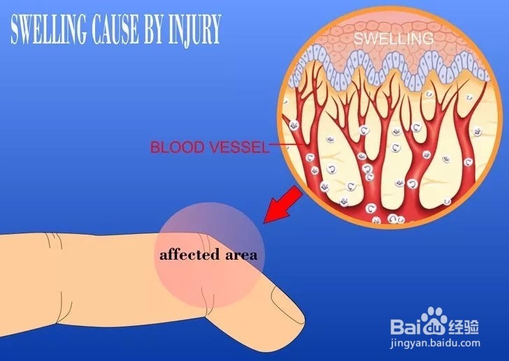 怎样减轻手指肿胀?