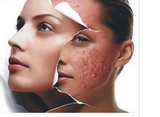 去痘最有效的产品