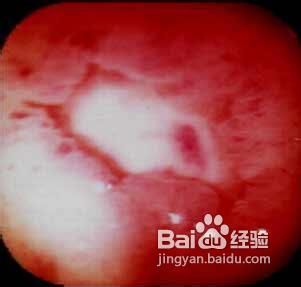 感染了幽门螺杆菌会有什么害处