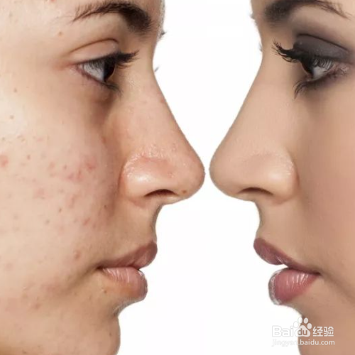 脸上长痘先涂药还是护肤品