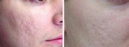 什么叫痤疮及如何治疗