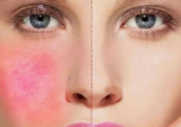 如何去除红血丝