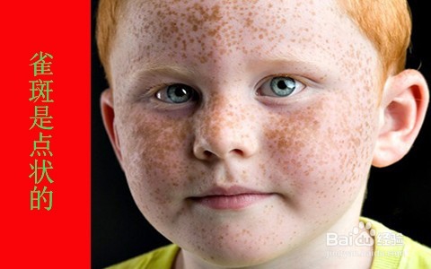 一次性祛斑方法/雀斑能一次性去除吗