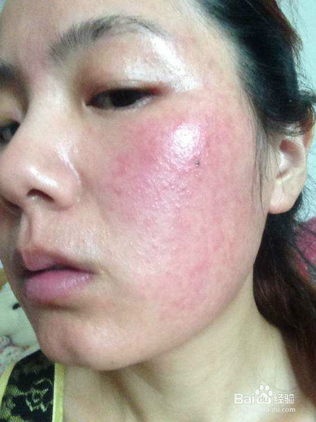 怎么去脸上红血丝