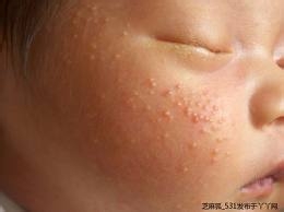婴儿常见症状及其护理：[1]新生儿痤疮