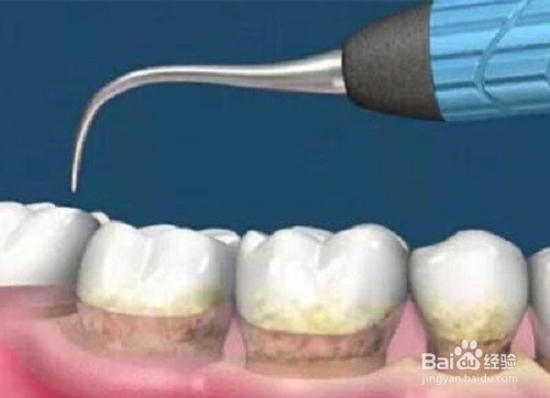 洗牙的好处与坏处