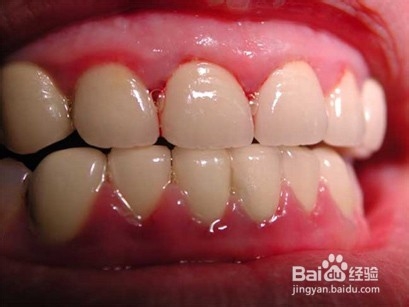 牙龈出血 有什么危害怎么办