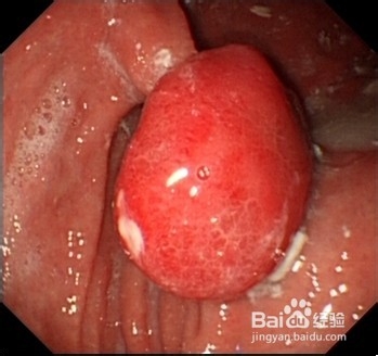如何有效防止胃息肉的发生