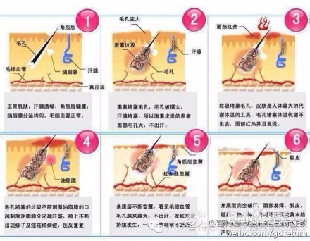 如何防止脸上痘痘发炎
