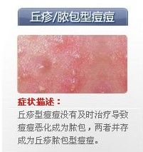 痘痘的种类有哪些