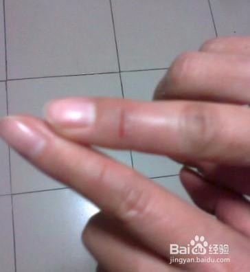 红霉素软膏的妙用