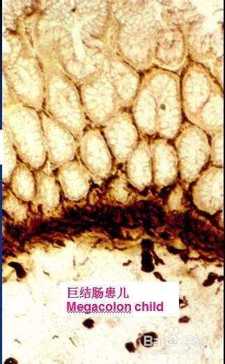 儿童常见疾病一先天性巨结肠。
