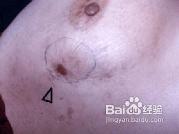 乳腺癌到了晚期哪些症状表现