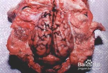 常见内科病之传染病治疗方法：[2]流行脑膜炎