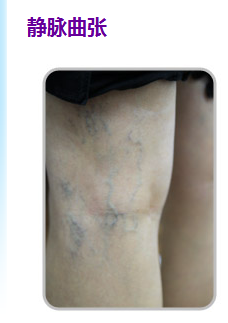 什么是静脉曲张