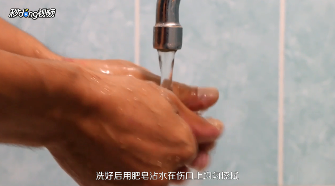 被蚂蚁咬伤怎么办