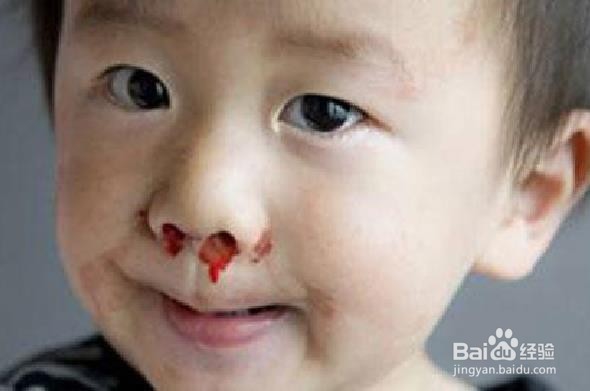 家长如何应对孩子流鼻血