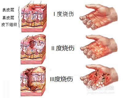 烧伤后不能用冰敷，你知道吗？
