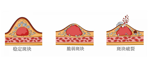 心绞痛怎样治疗	心绞痛是什么原因引起的？