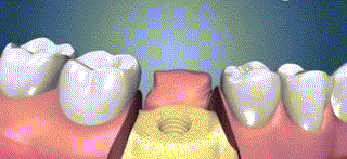 种植牙真的有那么好吗?