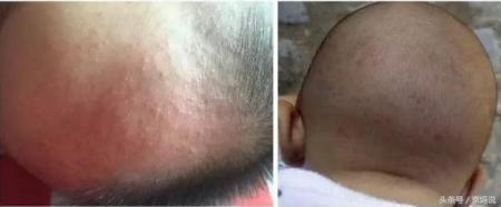 起红疹就一定是热痱吗？3招教你预防宝宝长痱子！