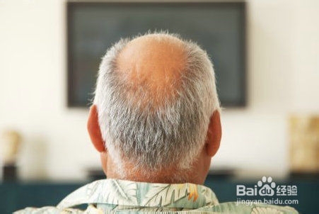 如何预防秃顶