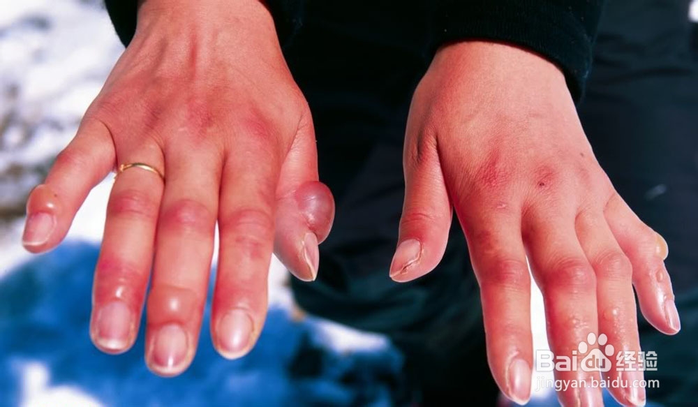 冬季手长冻疮了怎么办？