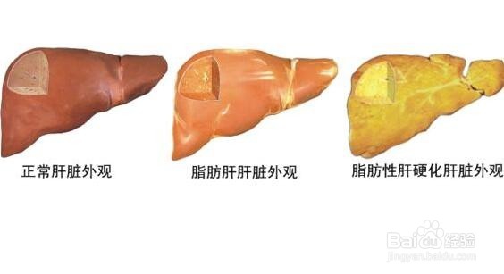 脂肪肝传染吗
