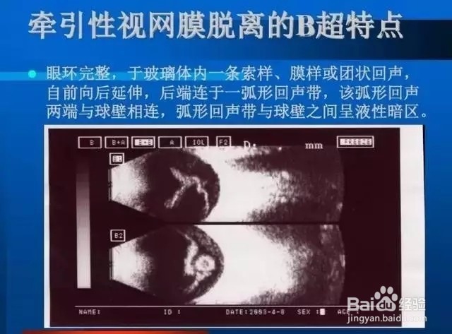 几种常见眼病B超图谱及诊断