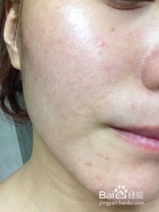 教你如何调理暗疮性皮肤