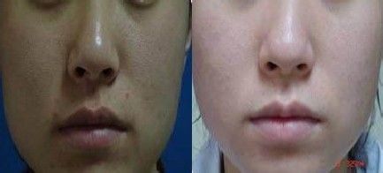 去黑头怎么收缩毛孔