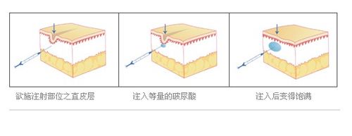 注射玻尿酸的优势有哪些，注射玻尿酸适用人群