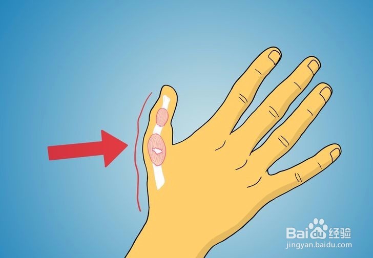 如何诊断拇指是否骨折?