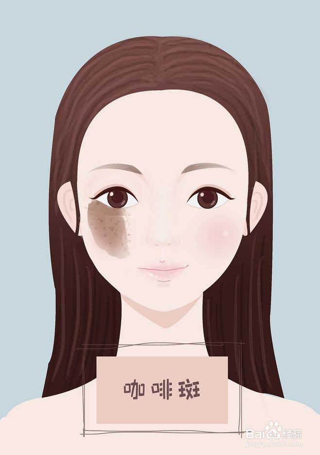 如何治疗咖啡斑