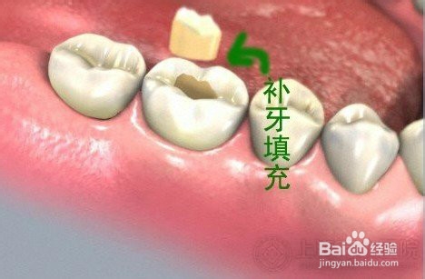 补牙虫牙全过程是怎么样的？