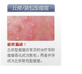 世上最全面治疗痘痘大全