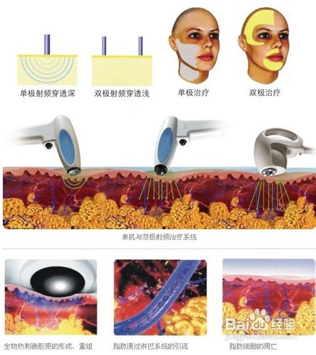 单/双极的射频治疗系统,可以根据不同的部位,不同的皮肤结构及目的