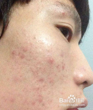 怎么才能把痘印去掉