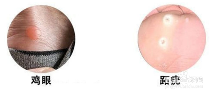怎么分辨鸡眼和跖疣,认清跖疣是什么原因造成的