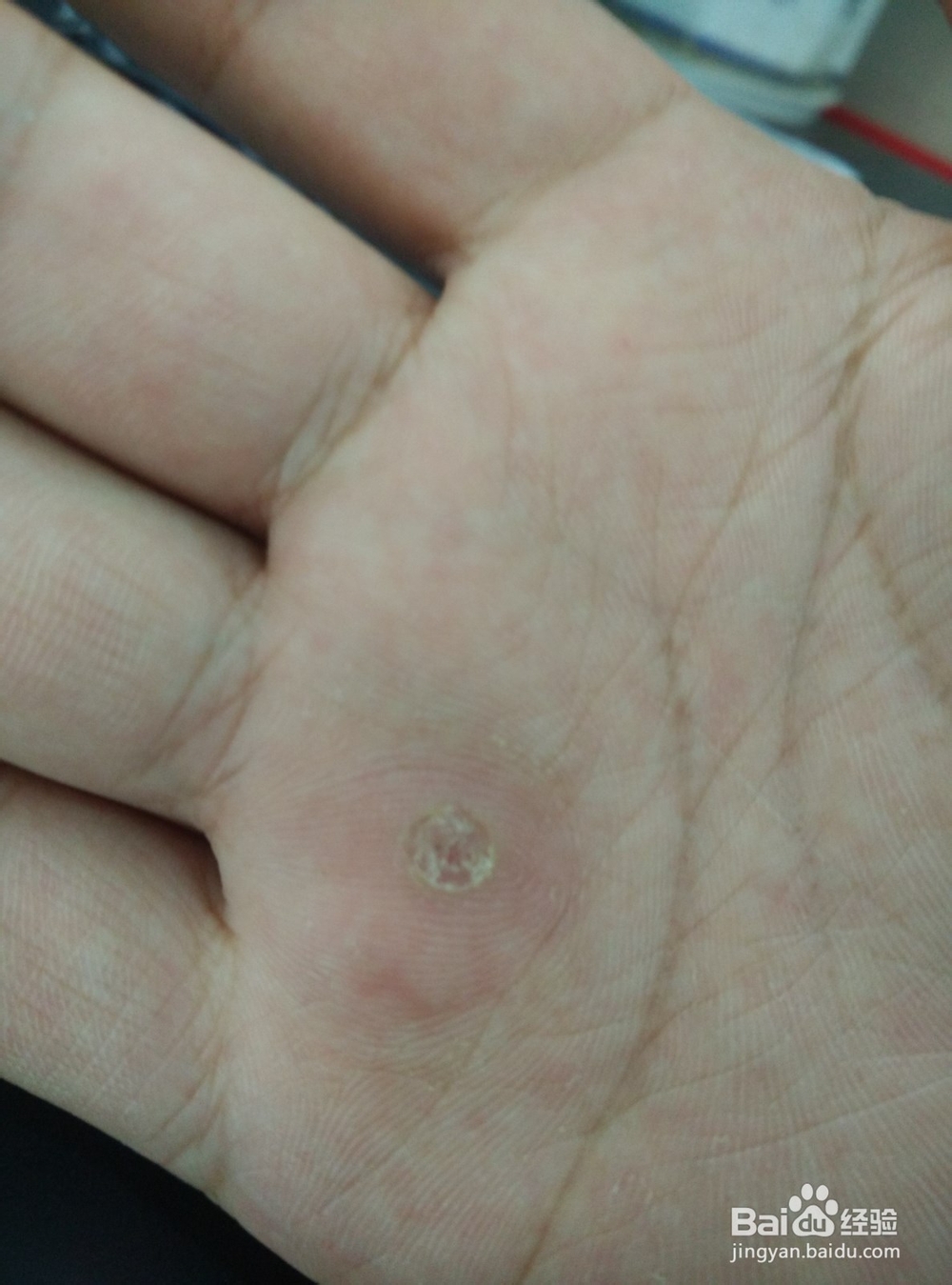 寻常疣治疗方法
