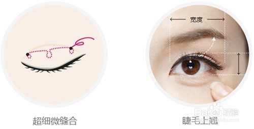 双眼皮手术有几种