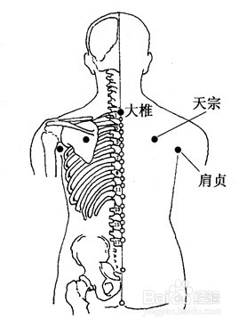 百病拔罐：[37]肩周炎的拔罐疗法