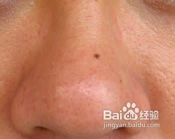 怎样去除黑头更有效