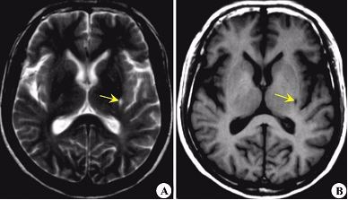 脑梗塞的患者应该注意什么？