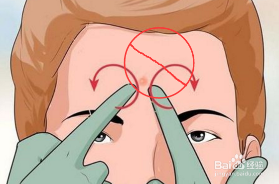 怎么去掉脸上的痤疮